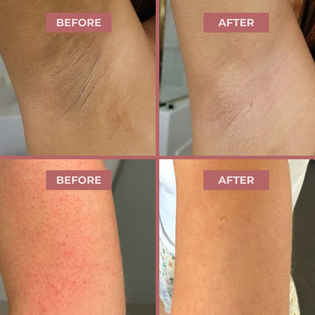 Peel Shot - Kojic + Turmeric Body Peel Spray