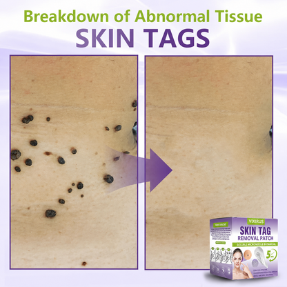 VIXIRUS® Soluble Microneedle Botanical Skin Tag Removal Patch