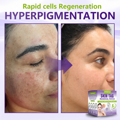VIXIRUS® Soluble Microneedle Botanical Skin Tag Removal Patch