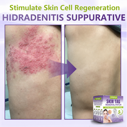 VIXIRUS® Soluble Microneedle Botanical Skin Tag Removal Patch